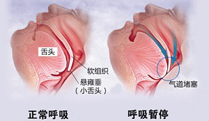 打呼噜的常见症状有哪些