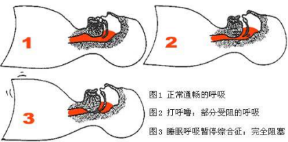 怎样防止打呼噜?该如何预防?