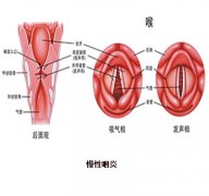 慢性咽炎的常见症状有哪些