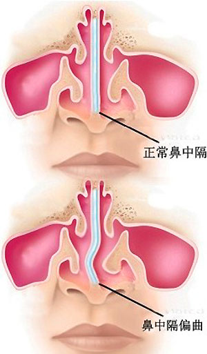鼻中隔偏曲与正常对比.jpg