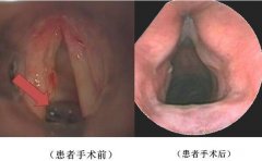 声带小结有必要做手术么