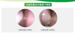看耳鼻咽喉科哪里好 有过敏性鼻炎