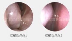 检查过敏性鼻炎做过敏源筛多少钱