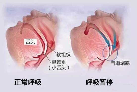 打呼噜竟也是病,甚至引发猝死