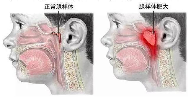 “呼噜娃”,成我院最小扁桃体手术患者