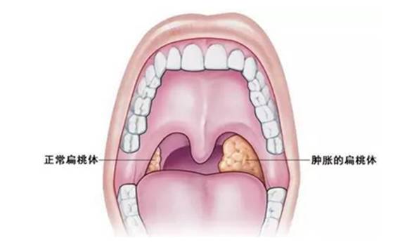 “呼噜娃”,成我院最小扁桃体手术患者