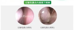 过敏性鼻炎有没有彻底摆脱的治疗方法
