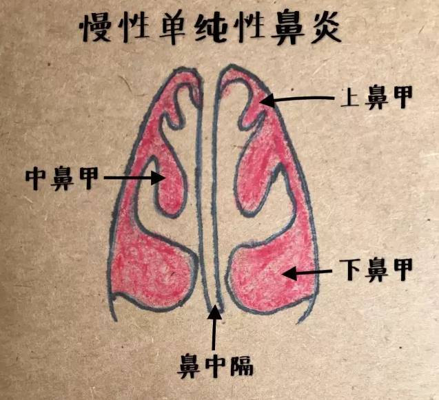 慢性肥厚性鼻炎