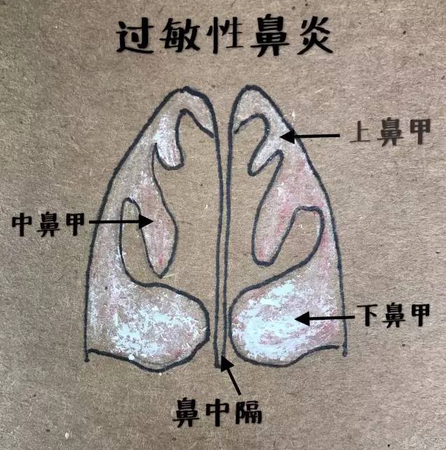 过敏性鼻炎