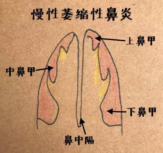 感冒花了那么多冤枉钱还不好,可能患上鼻炎