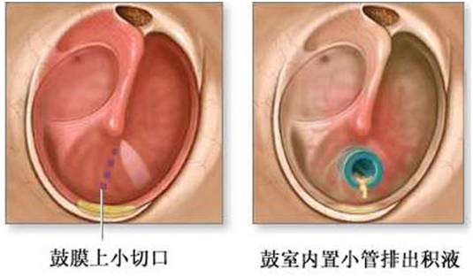 腺样体引发的分泌性中耳炎的治疗