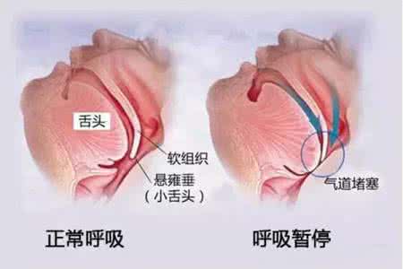 儿童睡觉打呼噜如何治疗好