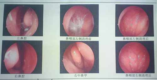 南京过敏性鼻炎的治疗方法