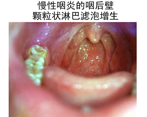 慢性咽炎的咽后壁颗粒状淋巴滤泡增生