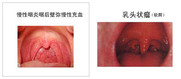 慢性咽炎类型