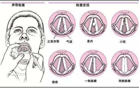 如何避免声带息肉的发生?